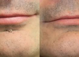 ✨Virellora®2-in-1 Microneedle & Hydrocolloid Patch