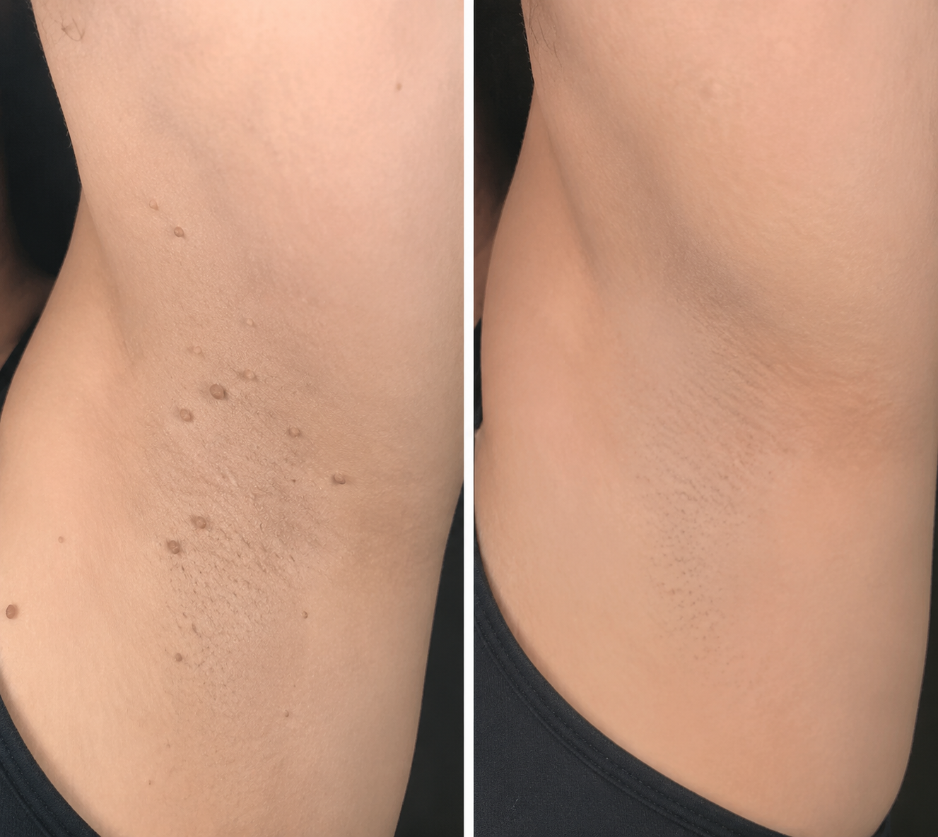✨Virellora®2-in-1 Microneedle & Hydrocolloid Patch