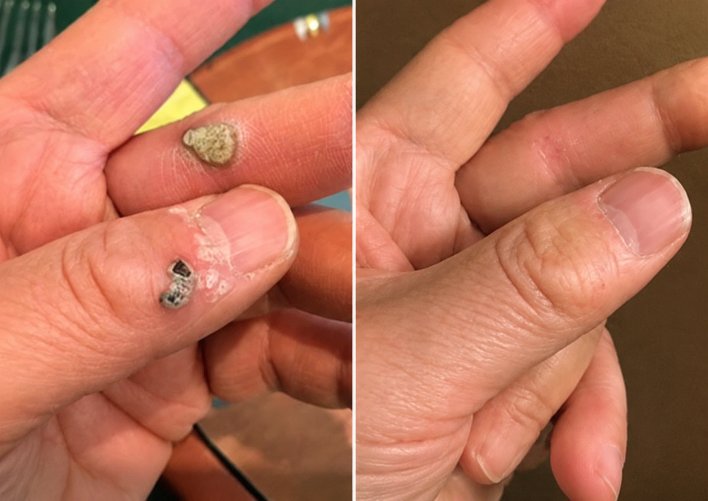 ✨Virellora®2-in-1 Microneedle & Hydrocolloid Patch